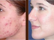 Cum să scapi de acnee, folosind un tratament cu salată verde