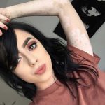 fata-vitiligo1