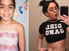 A fost batjocorită toată viaţa pentru că avea o boală de piele, dar acum arată senzaţional fata cu harta pe corp