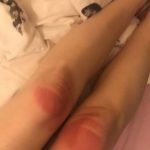 arsura prin blugi taiati9
