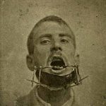 imagini-ciudate-din-trecut-fractura-maxilarului