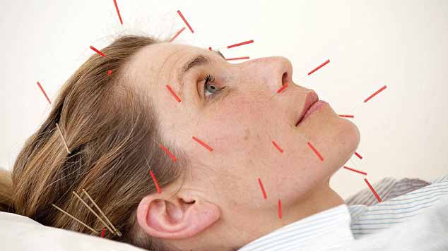 acupunctura chinezeasca