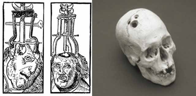 trepanatie