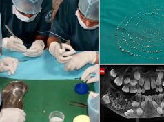 Doctorii au scos 526 de dinţi din gura unui copil de 7 ani 526 de dinţi