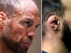 Ce este urechea conopidă. De ce să nu superi un om cu o astfel de malformaţie urechea conopidă