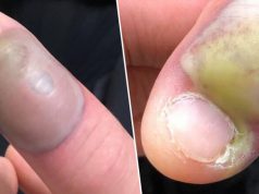 Rosul unghiilor poate fi periculos. O femeie a contractat o infecţie mortală rosul unghiilor