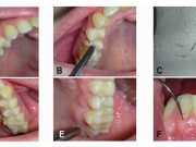Caz medical extrem de rar: Unei femei i-a crescut păr în gingie păr în gingie