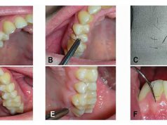 Caz medical extrem de rar: Unei femei i-a crescut păr în gingie păr în gingie