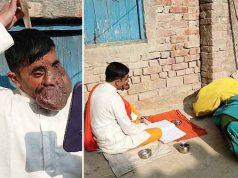 Preot cu o tumoră masivă pe faţă, venerat ca zeu de oamenii din satul său preot cu o tumoră masivă