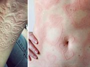 Ce este dermatografia şi cum trăiesc oamenii cu această afecţiune ce este dermatografia