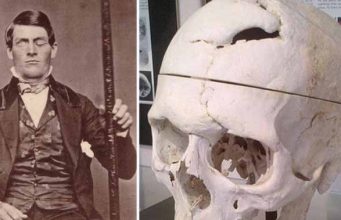 Phineas Gage