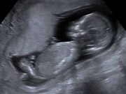 Himera umană: Cum a făcut un copil, un om care nu a existat himera umană