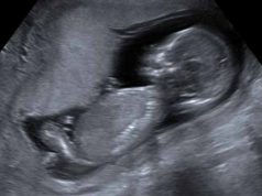 Himera umană: Cum a făcut un copil, un om care nu a existat himera umană