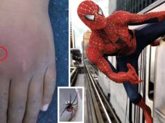 Un băiat s-a lăsat muşcat de o văduvă neagră pentru a deveni Spider-Man muşcat de o văduvă neagră