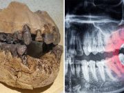 De ce au oamenii măsele de minte şi care a fost rolul lor în evoluţia speciei umane măsele de minte