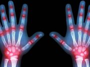 Artrita juvenilă afectează mii de copii, iar acest sfat simplu se dovedeşte a fi crucial artrita juvenilă