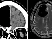 Acestui bărbat i-a „dispărut o bucată de creier” dintr-un motiv foarte ciudat dispărut o bucată de creier