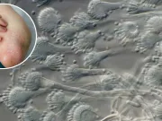 Infecțiile fungice mortale provoacă o „pandemie tăcută”, avertizează oamenii de știință infecţiile fungice