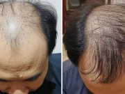 Căderea părului ar putea fi tratată prin simpla „apăsare” unui „comutator” molecular căderea părului