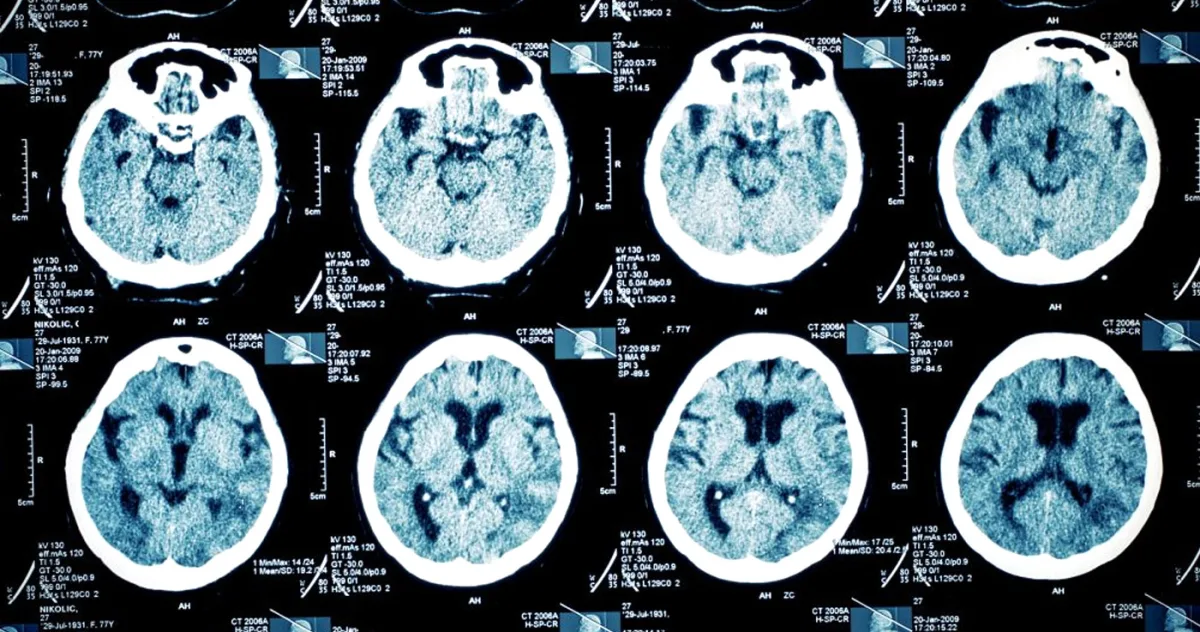 după 31 de ani de depresie severă