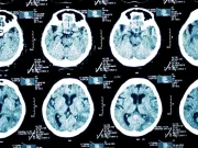 Un implant cerebral experimental a adus „o bucurie copleșitoare” unui bărbat după 31 de ani de depresie severă după 31 de ani de depresie severă