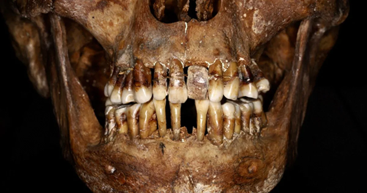 Secretul dureros al unei aristocrate de acum 400 de ani: își lega dinții cu sârmă de aur pentru a nu-și pierde statutul