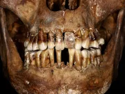 Secretul dureros al unei aristocrate de acum 400 de ani: își lega dinții cu sârmă de aur pentru a nu-și pierde statutul Secretul dureros al unei aristocrate de acum 400 de ani: își lega dinții cu sârmă de aur pentru a nu-și pierde statutul