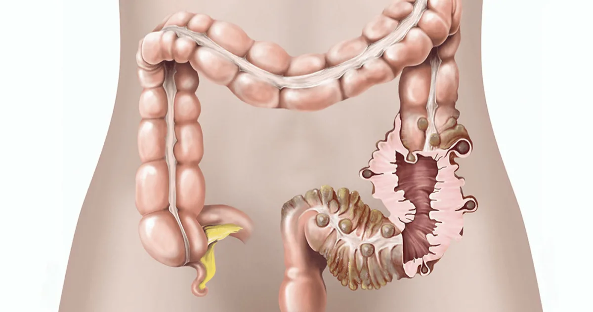 diverticuloza Afecțiunea tăcută pe care 70% dintre noi o dezvoltă până la 80 de ani