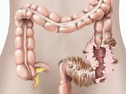 Afecțiunea tăcută pe care 70% dintre noi o dezvoltă până la 80 de ani. Ce este diverticuloza și cum te poți proteja diverticuloza Afecțiunea tăcută pe care 70% dintre noi o dezvoltă până la 80 de ani