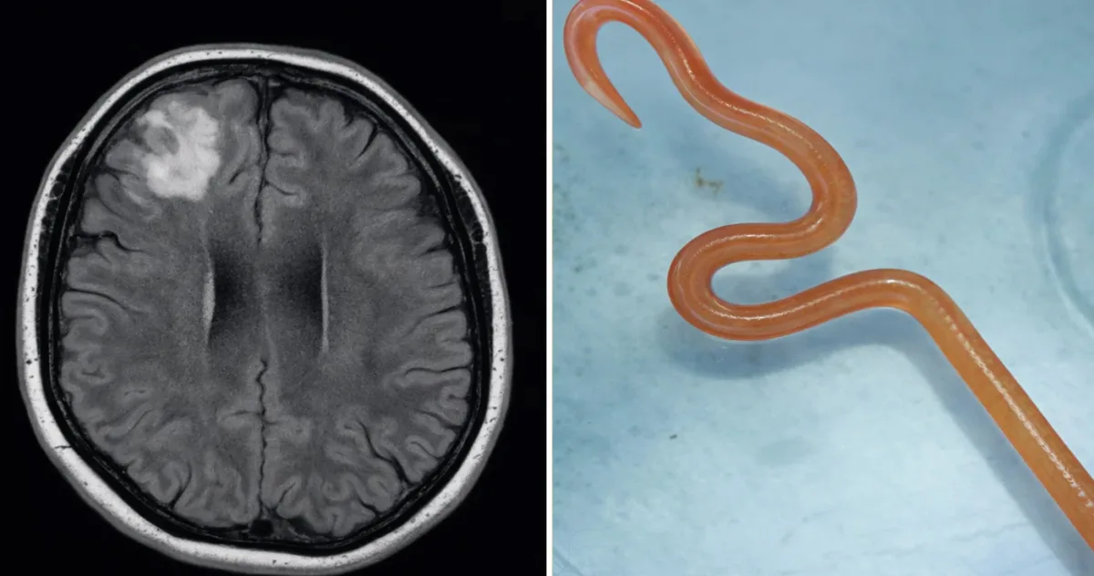 Primul caz din lume: un vierme viu de 8 cm a fost extras din creierul unei femei