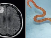 Primul caz din lume: un vierme viu de 8 cm a fost extras din creierul unei femei — și era roșu aprins Primul caz din lume: un vierme viu de 8 cm a fost extras din creierul unei femei