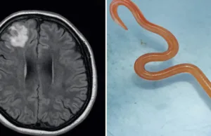 Primul caz din lume: un vierme viu de 8 cm a fost extras din creierul unei femei — și era roșu aprins Primul caz din lume: un vierme viu de 8 cm a fost extras din creierul unei femei