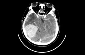 În 1984, o femeie a auzit voci spunându-i că are o tumoare pe creier. S-a dovedit că aveau dreptate Scanare CT pentru o tumoare pe creier
