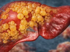 Consumul excesiv de alcool chiar și o singură dată pe lună îți poate tripla riscul de fibroză hepatică risc fibroză hepatică