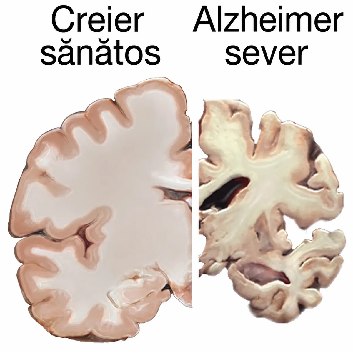 secțiuni ale unui creier sănătos (stânga) și ale unui creier afectat de boala Alzheimer în stadiu avansat (dreapta), care evidențiază pierderea țesutului cerebral