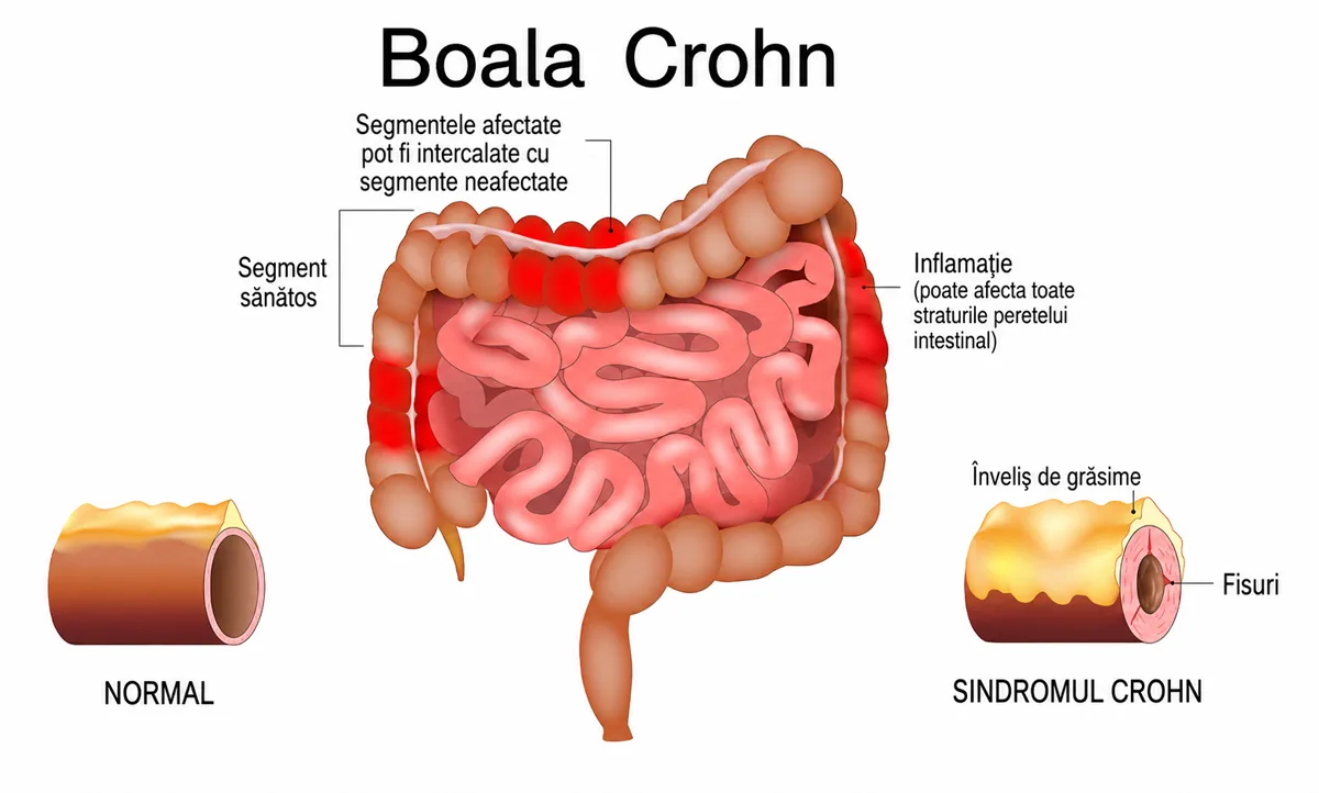 Boala Crohn