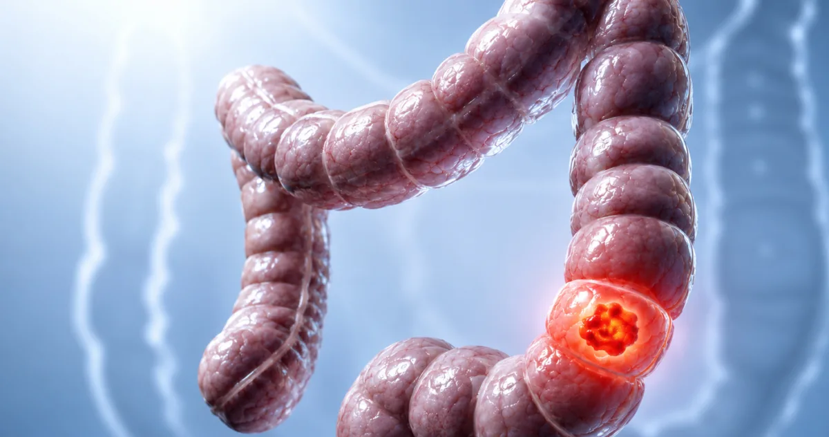 bacterie intestinală cancer colon