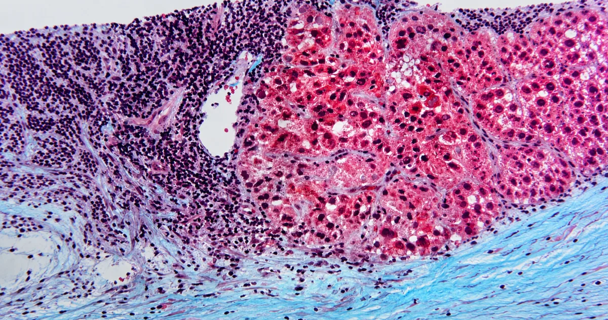 metabolismul celulelor canceroase