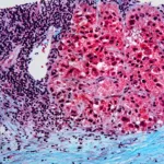 metabolismul celulelor canceroase