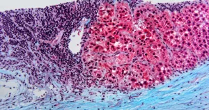 metabolismul celulelor canceroase
