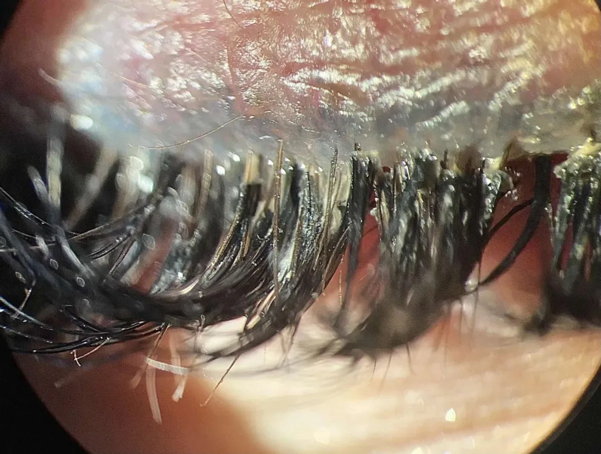 demodicoza oculara simptome