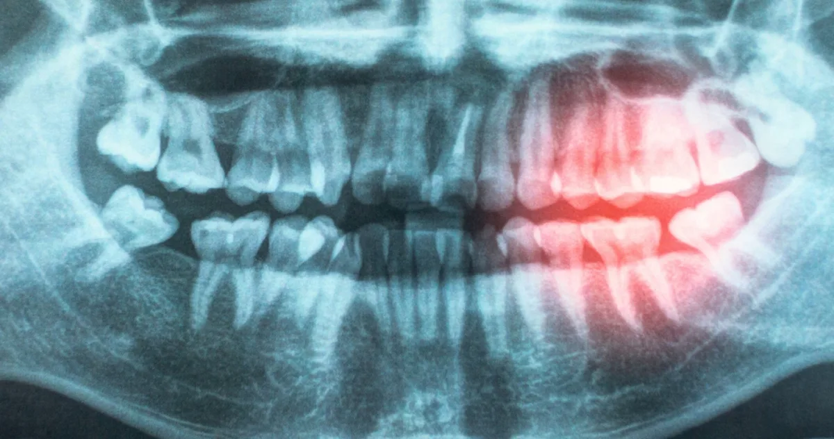 boli gingivale boli de inima