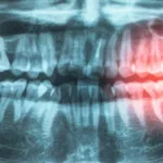 boli gingivale boli de inima