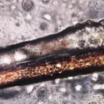 extensii de gene acarieni demodex