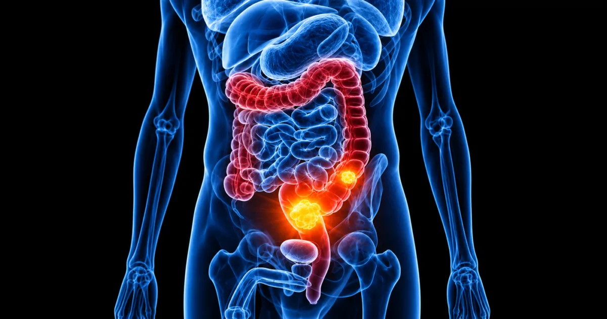 carne procesată cancer de colon
